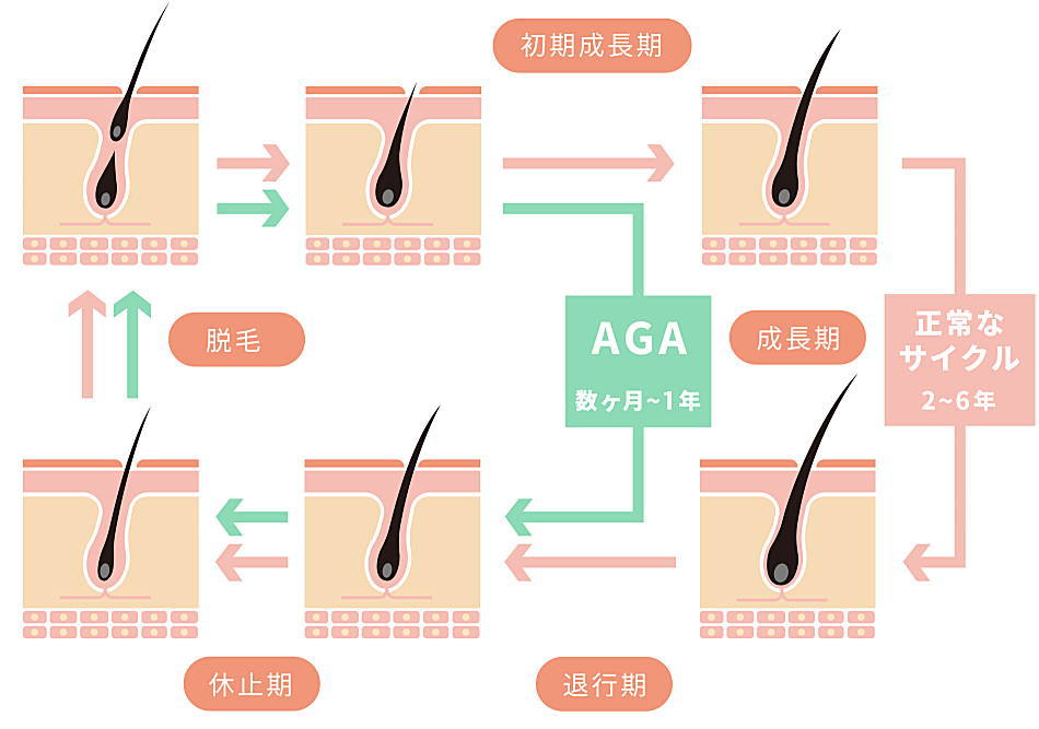 AGAの進行メカニズム