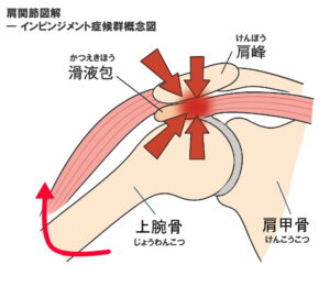 インピンジメント症候群の概念図
