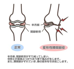 変形性膝関節症に有効な再生医療の効果とは