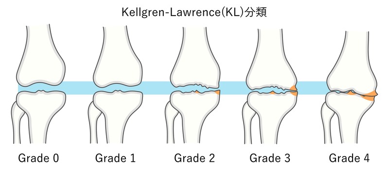 変形性ひざ関節症　ステージ分類（KL分類）概念図