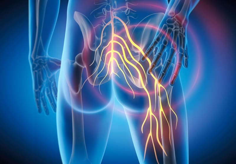 股関節と坐骨神経痛