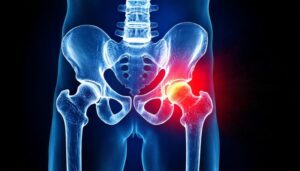 股関節 骨切術で後悔しないために知っておくべき選択基準